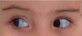 Figura 4. Escleras azules en paciente hija