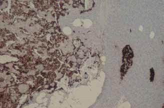 Figura 3. Inmunohistoquímica del tumor pancreático demostrando reacción para insulina